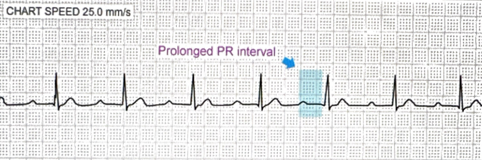 <p>PR interval >200 ms, but every P conducts</p>