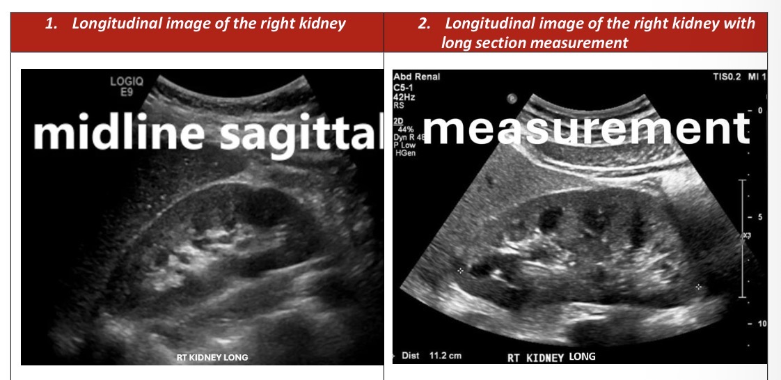<p>Right Kidney Longitudinal Survey</p>