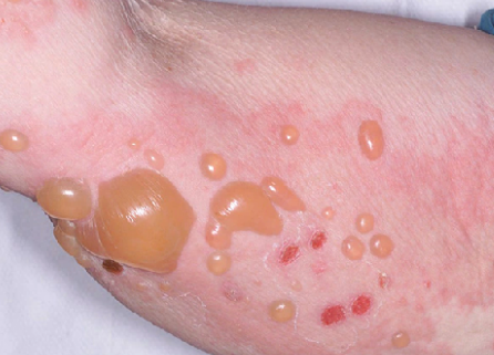 <p><span>bullae or blebs</span></p>