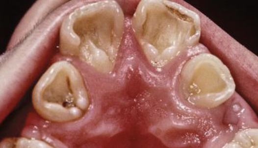<p>prominent marginal ridges on max incisors (esp centrals), associated w/ dens evaginatus, usually bilateral, most common in asians </p>