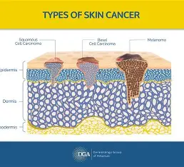 <p>Melanoma</p>