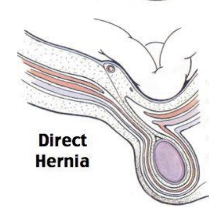 <p>Direct Hernia</p>