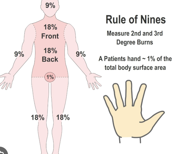 <p>to determine the amount of body surface area that has been burned only for <strong>partial thickness (2nd degree) and full thickness burns (3rd degree)</strong></p>
