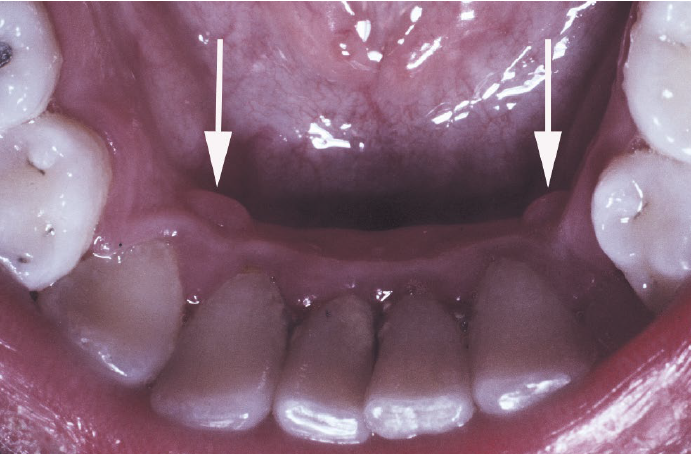 <ul><li><p><strong>a normal anatomic variation</strong></p></li><li><p>on the<strong> gingiva lingual to the mandibular cuspid</strong>, frequently bilateral</p></li><li><p>microscopically like giant cell fibroma</p></li><li><p>no need for treatment</p></li></ul><p></p>