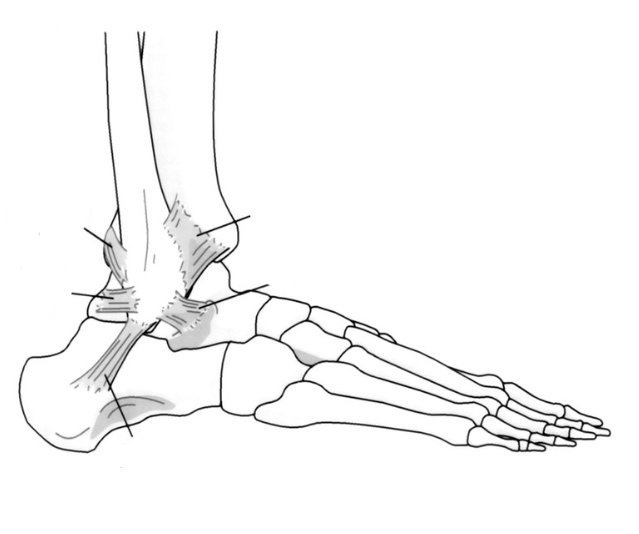 <p>Where is the <span><span>Anterior Talofibular (ATF)</span></span></p>