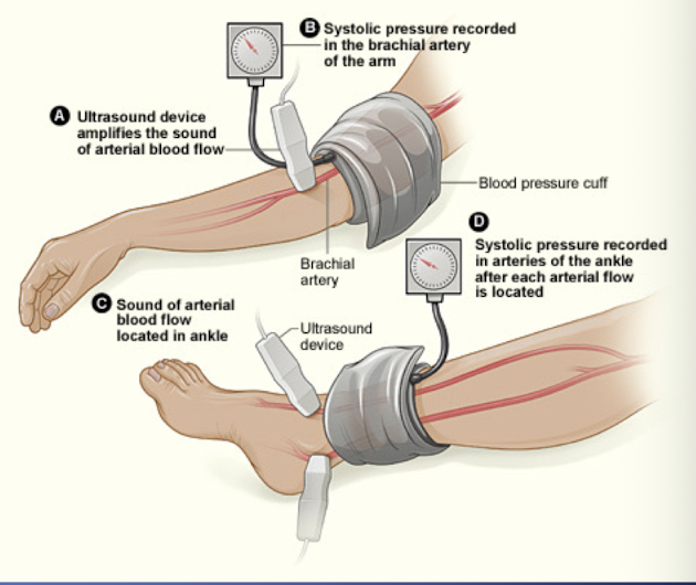 <p>-Average ankle pressure/ average arm pressure</p><p>>1.4: non-compressible calcification of vessel→ refer to vascular specialist</p><p>-1.0-1.4: normal, no blockage→ no treatment</p><p>-0.9-1.0: borderline→ your ABI is slightly lower than normal but not low enough to diagnose PAD</p><p>-0.8-0.99: mild arterial disease→ treat risk factors </p><p>-0.5-0.79: moderate blockage→ refer to vascular specialist</p><p>-<0.5: severe blockage→ refer to vascular specialist</p>