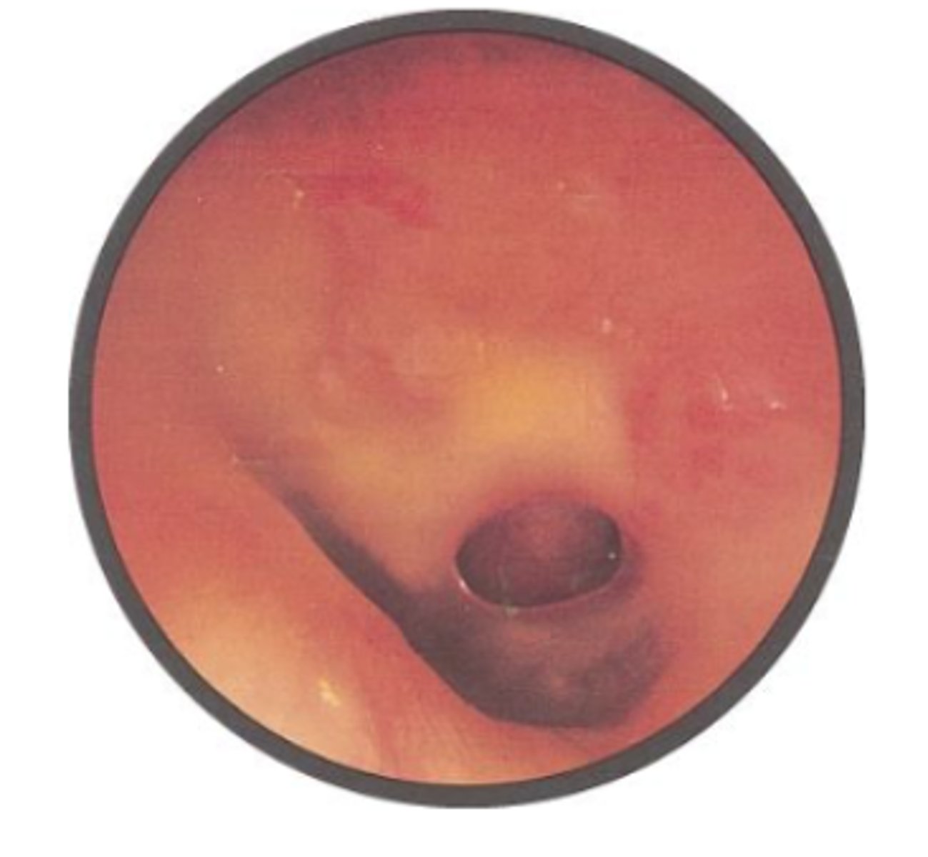 <p>Perforations are holes in the eardrum caused by middle ear infections, strong blast forces (explosion, hit, etc)</p><p>Large perforations can result in earache, redness, inflammation, and hearing loss as infections can cause discharge to drain out through the perforated opening</p>