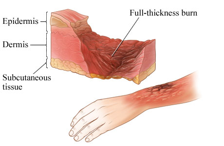 <p>Third degree </p>