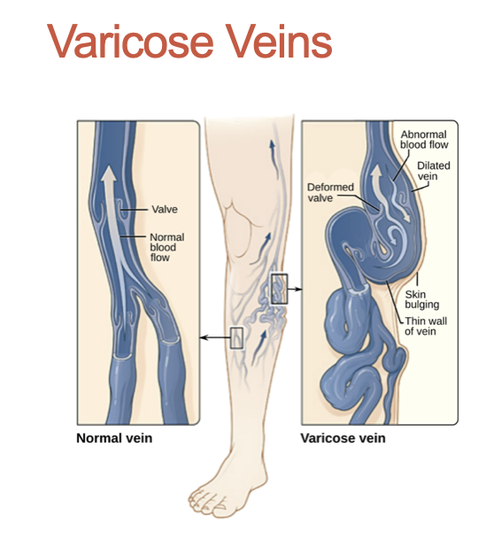 <p>What are Varicose Veins caused by? Who are they more common in? Are they Hereditary?</p>