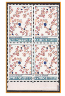 <p>- Thomas Cooley described Thalasasmia in 1925</p><p>- Italian children with severe anaemia, enlarged spleen and distinctive appearance due to bone deformities (facial)</p><p>- High prevalence around Mediterranean sea</p><p>- deficienct synthesis of globin chains of Hb</p><p>- Classified by clinical severity</p>