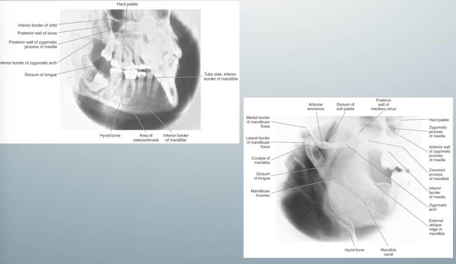 <p>-used to evaluate mandibular body and ramus</p><p>-inferior border of the image receptor parallel and at least 2 cm below the inferior border of the mandible so that the image receptor can cover the entire mandibular body and ramus</p>