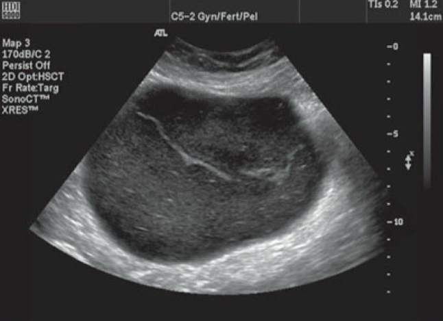 <p>This is an example of _______ (mucious Cystadenoma/ Mucinous Cystadenocarcinoma) + is seen with ____ (echogenic/ Anechoic) material inside </p>