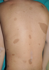 <p>The presence of six or more café-au-lait spots larger than 5 mm in a prepubescent child suggests the diagnosis.</p>