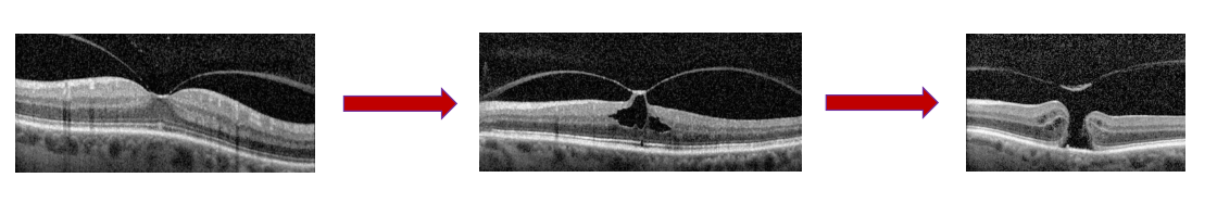 <ul><li><p>During a PVD strong adhesions may remain on the fovea</p></li><li><p>As the vitreous pulls away, this pulls the macula from the RPE</p><ul><li><p>→ Central scotoma</p></li></ul></li></ul><p></p>