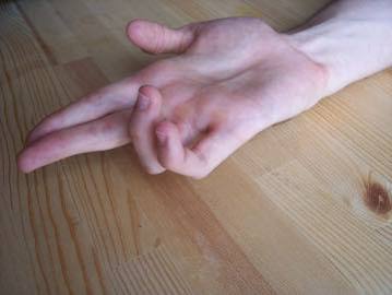 <p>Ulnar “claw hand”: IP flexion & hyperextension at MCP joint</p><p><span>Tingling or numbness in the little finger and the ulnar half (inner side) of the ring finger, weakness in grip, clumsiness, difficulty spreading or bringing the fingers together, and atropy of hand muscles</span></p><p></p>