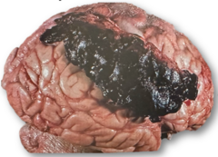 <p>Why can a subdural hematoma enlarge over time?</p>
