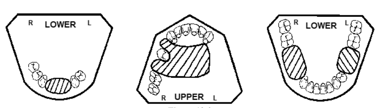 <p>What is the sequence for creating a remount cast?</p>