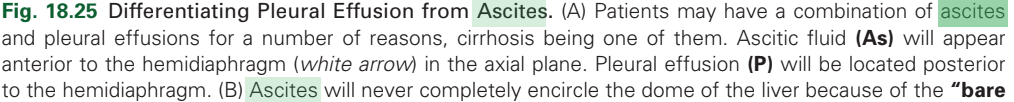 <p>ascites and pleural effusion</p>