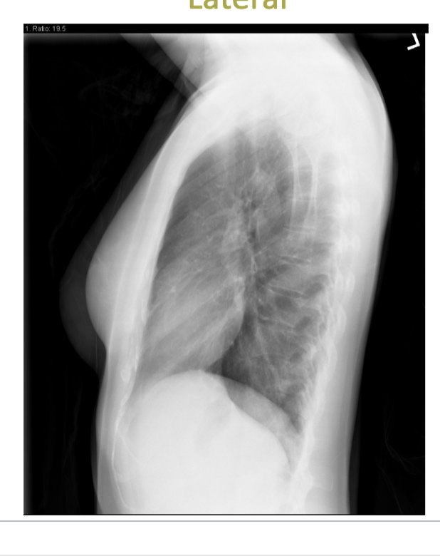 <p>which type of projection is attached? </p>