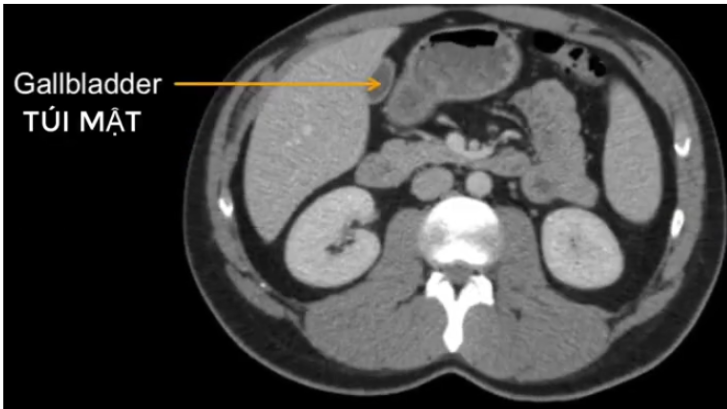 <p>a) Túi mật TA viết là?</p><p>b) Niệu quản ở?</p>