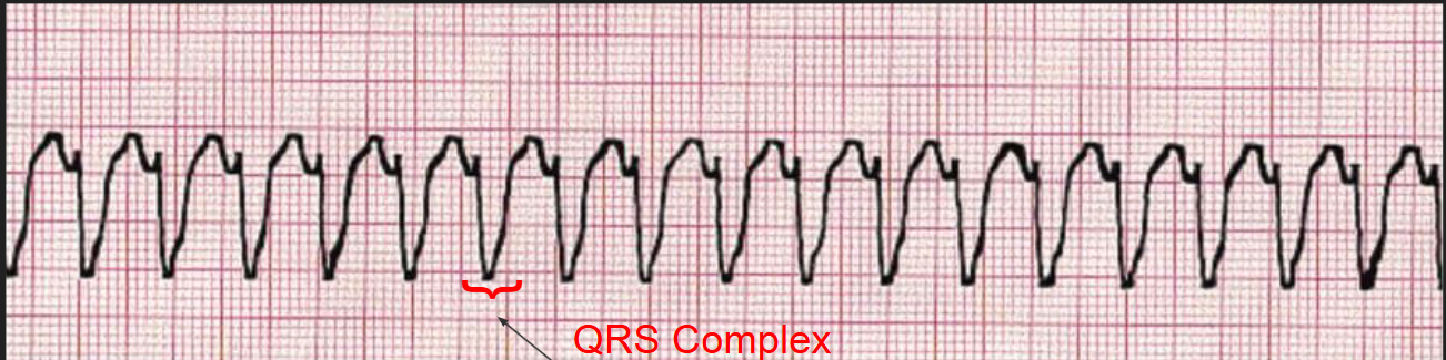 <p>Ventricles <strong>contract quicker than atrial blood</strong> can fill them, causing no pulse.</p><p></p><p>EKG shows a <strong>fast regular rhythm</strong>, but with <strong>wide QRS complexes</strong>, and tachyarrhythmia originates in the ventricles. Without intervention, this will lead to death.</p><p></p><p>Purkinje cells themselves can become the source of an abnormal electrical impulse: Catecholaminergic polymorphic ventricular tachycardia (CPVT)</p><p></p><p>Shockable rhythm!</p>