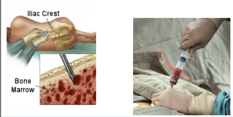 <p><span style="background-color: transparent;"><strong>Bone marrow aspiration</strong></span></p>