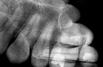 <p>Double Image </p><p><strong>What it looks like:</strong><br>Two images overlap.</p>