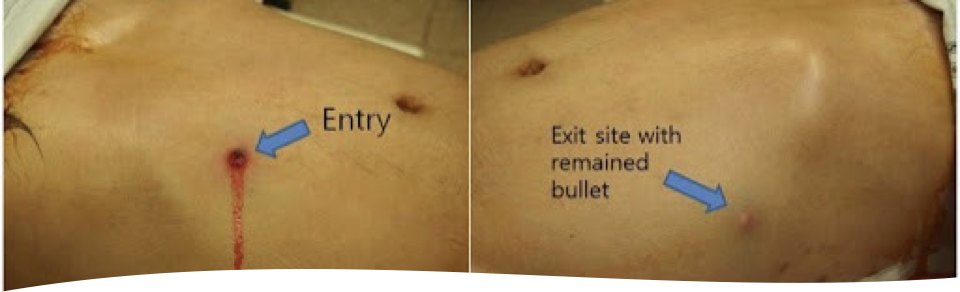 <p>What does this refer to</p><ul><li><p>Stab wounds/low energy GSW</p><ul><li><p>Lacerating and tearing</p></li></ul></li><li><p>High energy GSW</p><ul><li><p>Transfers greater kinetic injury</p></li><li><p>Increased damage around the track of the missile</p></li></ul></li></ul><p></p>