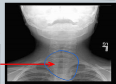 <p>preschool/school age children</p><p>Superinfection of the trachea that may follow viral croup and most commonly caused by S. aureus</p><p>High fever, toxic appearance, stridor, thick purulent secretions, poor response to racemic epinephrine</p><table style="min-width: 25px;"><colgroup><col style="min-width: 25px;"></colgroup><tbody><tr><td colspan="1" rowspan="1"><p></p></td></tr></tbody></table><table style="width: 343px;"><colgroup><col style="width: 343px;"></colgroup><tbody><tr><td colspan="1" rowspan="1" colwidth="343"><p>Irregular tracheal narrowing, subglottic edema in imagining </p></td></tr></tbody></table><p></p>