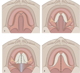 <p>What is this cleft palate repair technique?</p>