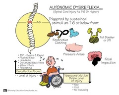 <p>a life-threatening emergency in spinal cord injury patients (ABOVE T6) that causes a hypertensive emergency; it occurs AFTER spinal shock has resolved</p>