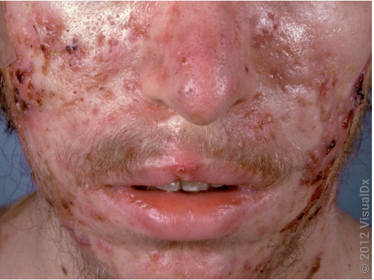 <p>A 17-year-old male presented to clinic with the following presentation for the past 6 months. He admits intermittent fevers and muscle aches. Recent labs demonstrated an elevated ESR and leukocytosis. He is currently using a salicylic acid face wash. Which medication would be initially indicated for his condition?</p>