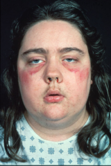 <p>Glucocorticoid excess</p><p>• Central obesity, "buffalo hump," "moon facies"</p><p>• Catabolism: thin skin, striae, myopathy, osteoporosis</p><p>• Insulin resistance and hyperglycemia/diabetes</p><p>• Psychiatric: irritability, depression, psychosis</p><p>• Immune impairment</p><p>Mineralocorticoid excess</p><p>• Sodium retention: hypertension, edema</p><p>• Hypokalemia</p><p>Androgen excess</p><p>• Hirsutism</p><p>• Amenorrhea</p>