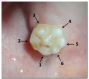 <p>associated with congenital syphilis</p><p>irregular, accentuated occlusal patterns</p>