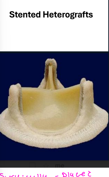 <p>• Sewing ring with 3 semi-rigid stents or struts</p><p>• Normal regurgitant volume 1 mL</p><p>• 10% demonstrate a small degree of regurgitation</p><p>by color flow imaging</p>