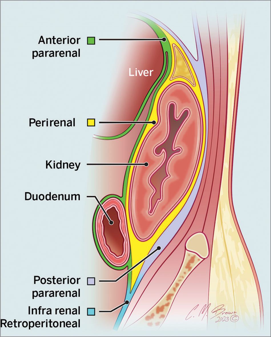 <p>Retroperitoneal</p>