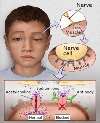 <p><span style="line-height: 23.25px; color: rgb(11, 9, 9);"><strong>Autoimmune disease causes muscle weakness because nerve signals do not properly activate the muscles. </strong></span></p>