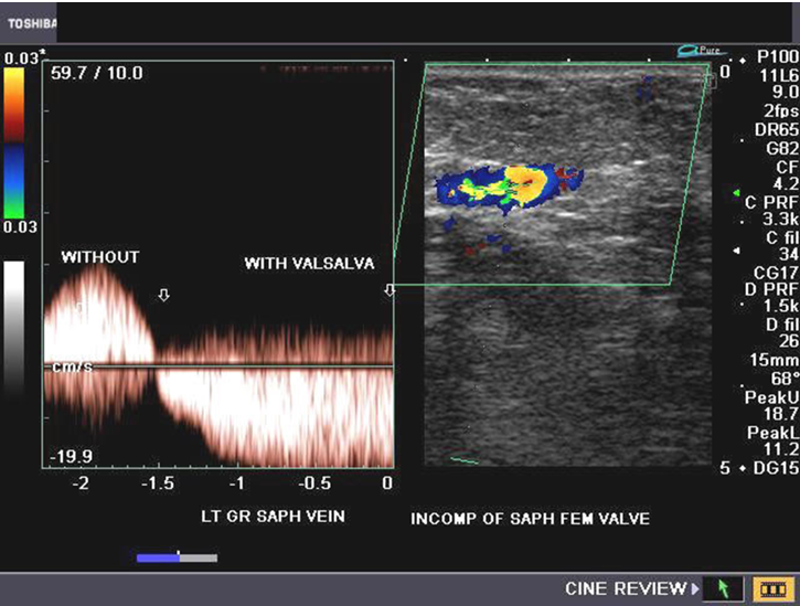 <p>abn → incomp vein</p>
