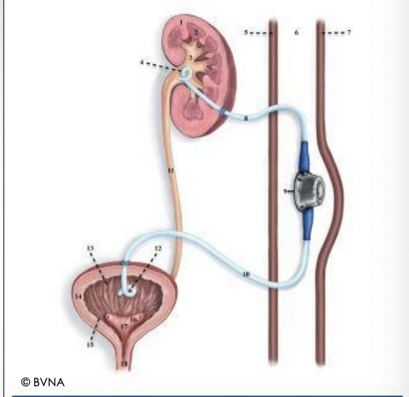 <p>What procedure in cats (abbreviated) uses a kidney catheter, shuntingport, and fenestrated bladder catheter to redirect urine flow from the renal pelvis to the bladder, avoiding the affected ureter? It can be used for obstructive ureterolithiasis, as one week of obstruction reduces kidney function by 35% and two weeks reduces it by 54%, and these reductions are permanent.</p>