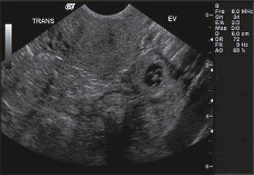 <p>1. Which of the following is present in Figure 23-27?</p><p>a. Anembryonic gestation</p><p>b. Molar pregnancy</p><p>c. Miscarriage</p><p>d. Ectopic pregnancy</p>
