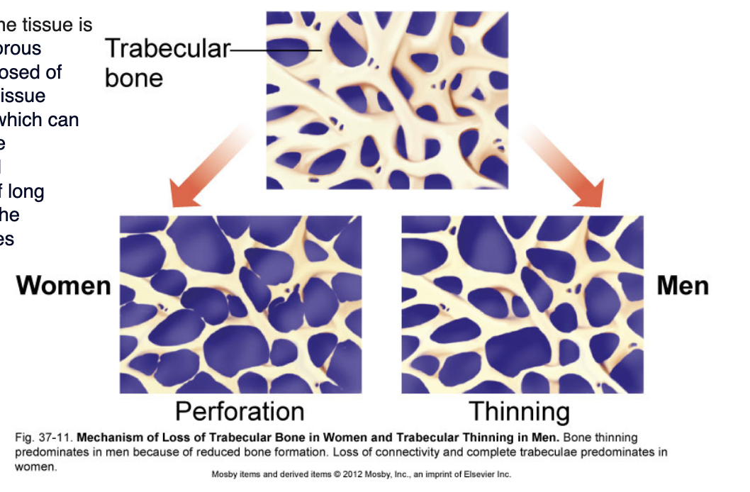 <p> spongy and porous bone material composed of hard and soft tissue components.</p><ul><li><p>long bones + vertebrae (shock absorbers)</p></li><li><p>RBCs </p></li><li><p>quick bone remodelling</p></li><li><p>highly sensitive to hormonal changes (women and loss of estrogen in menopause)</p><ul><li><p>see <strong>perforation</strong> in <strong>women</strong> (loss of connectivity and complete trabeculae) </p></li></ul></li><li><p>men = <strong>thinning</strong> </p><ul><li><p>hormonal decline more gradual </p></li></ul></li></ul><p></p>