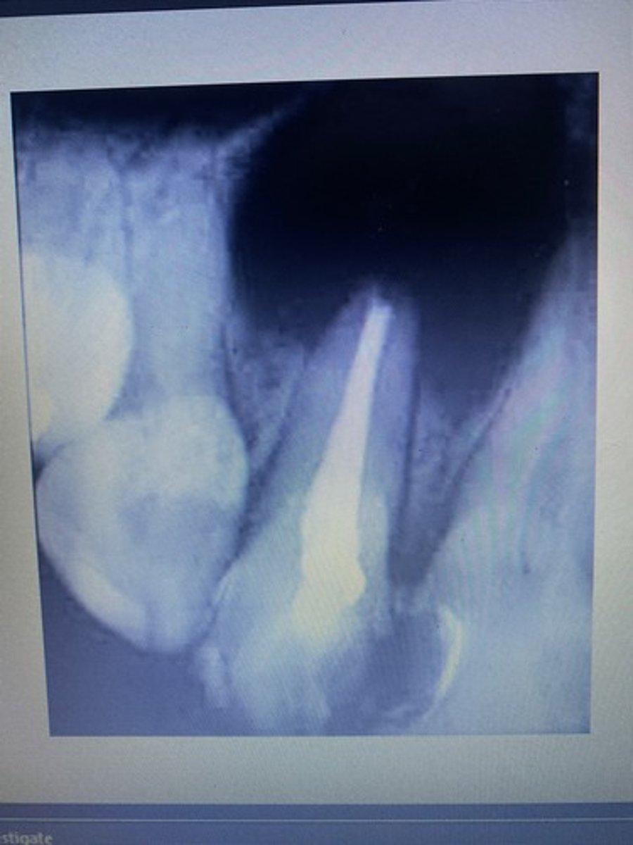<p><span>Name this condition (Most common cyst observed in the oral cavity, caused by pulpa inflammation and often a side effect of a long lasting or recurrent periapical infection)</span></p>