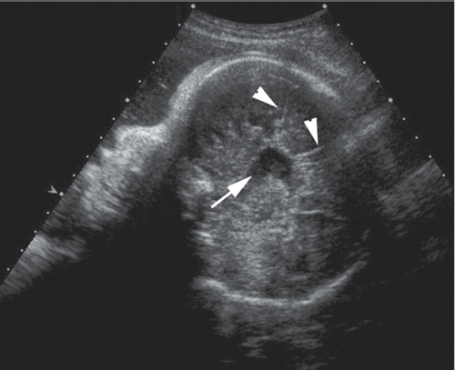 <p>Partial or complete absence of the corpus callosum and absence of the CSP (after 18 weeks)</p><p>“Sunburst” sign/ “spoke-wheel” pattern</p><p>Colpocephaly—(teardrop-shaped lateral ventricles)</p><p>Elevated and dilated third ventricle</p>