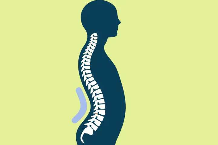 <p>A type of vertebral condition  </p>