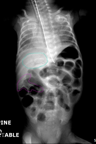 <p>Diagnose gebeurd via een RX, lucht in de darmwand wijst op NE.</p><p>Er zijn verschillende behandelingen die samen gebeuren:</p><p>-Voedingsstop → TPN of ORS om darm tot rust te laten komen.</p><p>-AB → bij ernstige darminfectie.</p><p>-Ondersteuning van de vitale parameters (invasief of niet invasief).</p><p>-Eventueel operatie → liefst afwachtende houding maar bij perforatie moet er geopereerd worden op peritonitis te voorkomen.</p>