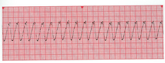 <p>A rapid heart rhythm in which the electrical impulse begins in the ventricle (instead of the atrium), which may result in inadequate blood flow and eventually deteriorate into cardiac arrest.</p>