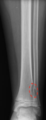 <p>What is this?</p><p>- 4-8 yo, male</p><p>- Asymptomatic</p><p>- Metaphyseal/ Diaphyseal - Distal femur</p>