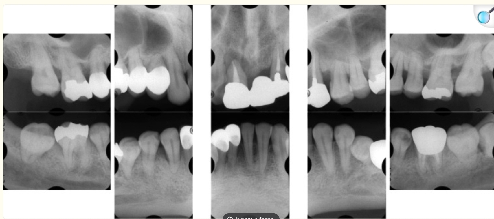 <p>Um homem de 39 anos compareceu ao departamento queixando-se de inchaço gengival, dor e mobilidade dentária; ele não tinha histórico de doenças sistêmicas. O exame inicial revelou higiene bucal precária com alto índice de placa bacteriana, além de diminuição significativa da dimensão vertical oclusal, ruptura do plano oclusal e desgaste de múltiplas próteses</p><p class="has-focus"></p>