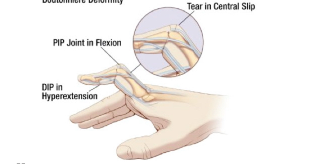 <p>What injury is seen w middle phalanx (dorsal base)</p>