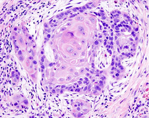 <p>CASE: A biopsy is unmistakably epithelial and also unmistakably invasive. Keratinization and atypia are intermediate between the well- and poorly-differentiated ends of the spectrum. What grade is most likely?</p>